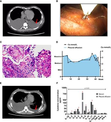 Deciphering the puzzle: a case report of Tjalma syndrome (pseudo-pseudo Meigs' syndrome) with profoundly elevated CA-125 and pleural effusion